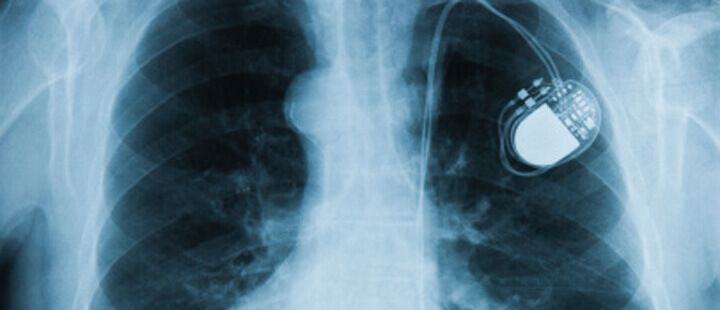 Pacemaker : comment fonctionne un pacemaker ? 